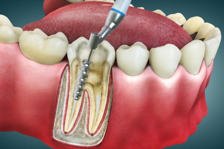root canal treatment in telugu